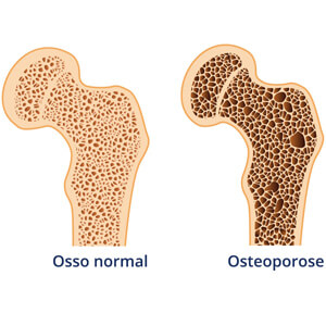 Tratamentos - Osteoporose